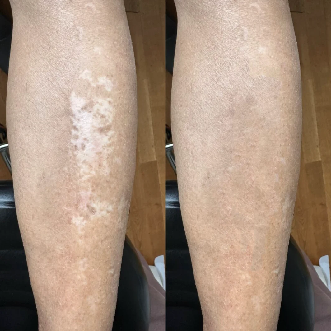 Camouflage & Tattoo Removal MasterClass – Ergebnis 2