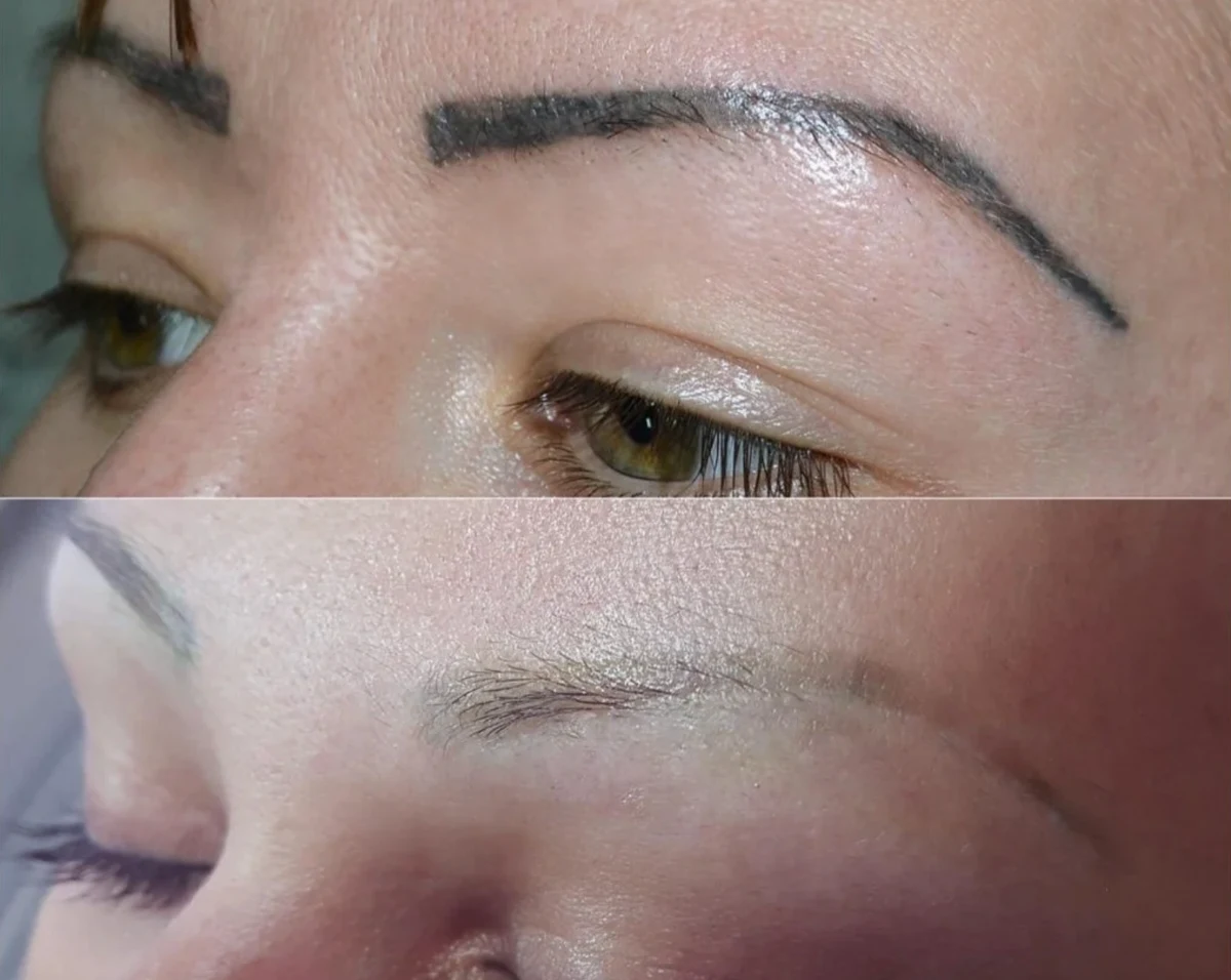 Camouflage & Tattoo Removal MasterClass – Ergebnis 3