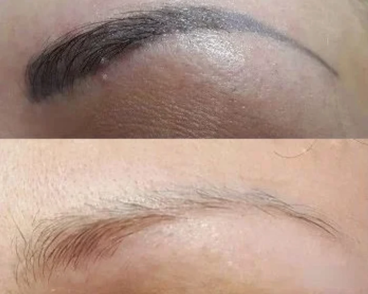 Camouflage & Tattoo Removal MasterClass – Ergebnis 4