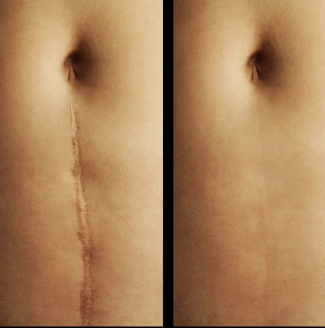 Camouflage & Tattoo Removal MasterClass – Ergebnis 7